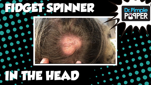 20 Year Old Fidget Spinner In the Head!