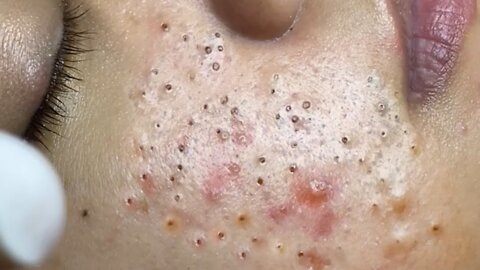 Removing Acne and Blackheads Treatment, #20