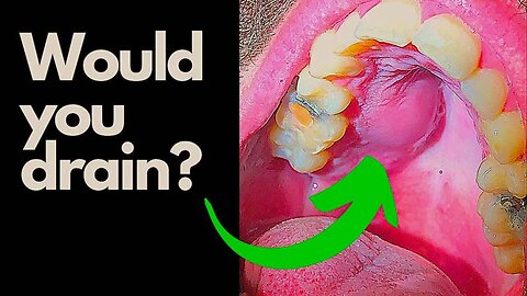 Tooth Abscess - Would you INCISE and Drain this Abcess?