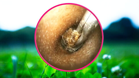 Ear Wax Removal With Clam Relaxing Music #01