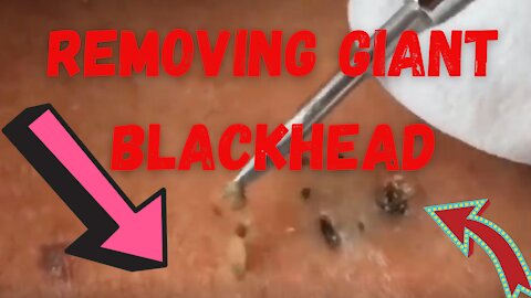 Blackheads and Whiteheads satisfying Giants Blackheads removal