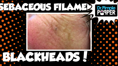 Two Women with Blackheads and Sebaceous Filaments