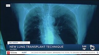 New Lung transplant technique surgery successful at UCSD Medical Center