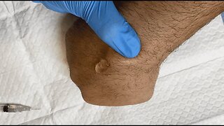 Drainage of a Ganglion Cyst