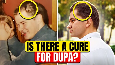 Diffuse Unpatterned Alopecia (Dupa)