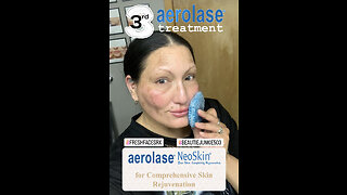 3rd Aerolase LightPod Treatment