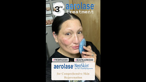 3rd Aerolase LightPod Treatment