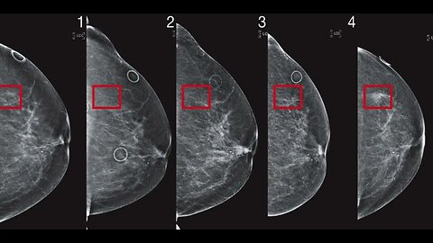 Not just a lump, 5 breast cancer signs many people don’t know about but should