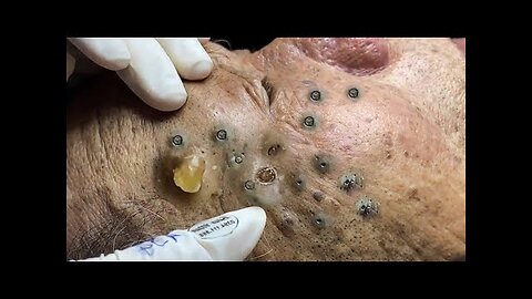 blackheads removal with Dr pimple popper, cystic acne & whiteheads extraction