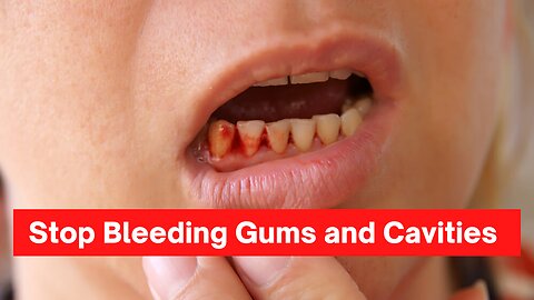 Teeth Cavity and Bleeding Gums Treatment!