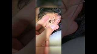 Remove Ear Wax Earwax Being Removed , Safely Remove Earwax at Home