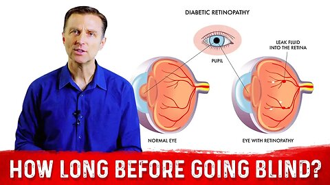 How Long Before A Diabetic Goes Blind? – Dr.Berg On Diabetic Retinopathy