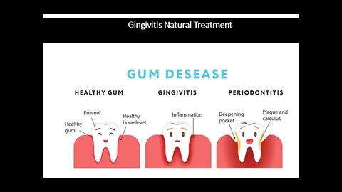 Gingivitis Natural Treatment