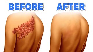 How to NEVER Get Shingles Again