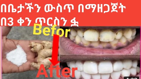 Ethiopia: how to clean teeth in 3 days | በ 3ቅን ውስጥ ጥርሳችንን ማፅዳት #new_tube