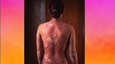 I’m Done Hiding My Psoriasis | SHAKE MY BEAUTY