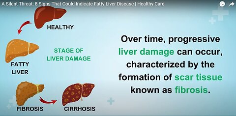 A Silent Threat: 8 Signs That Could Indicate Fatty Liver Disease