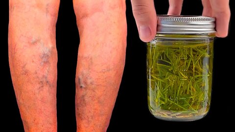 Get Rid Varicose Veins by using this Home Remedy