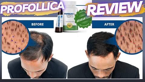 PROFOLLICA REVIEW 2023 - THE BEST HAIR LOSS TREATMENT 2023