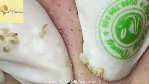 BIG Blackheads Removal Acne Treatment l Super blackheads l cravos