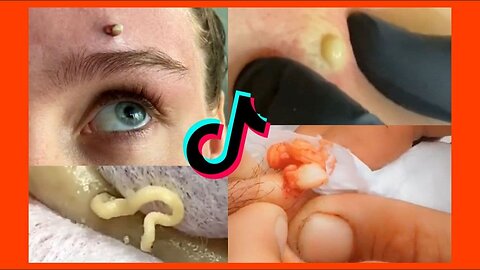 Satisfying Pimple Popping Compilation