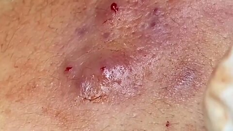 acne hematoma in cheeks and chin mụn viêm t (espinhas)
