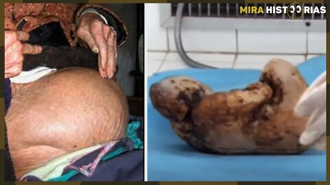 Esta mulher de 75 anos ficou grávida por 46 anos. Mas o que os médicos retiraram de dentro dela é...