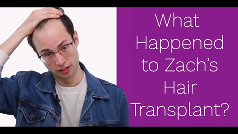 Zach From The Try Guys Hair Transplant- What Happened?