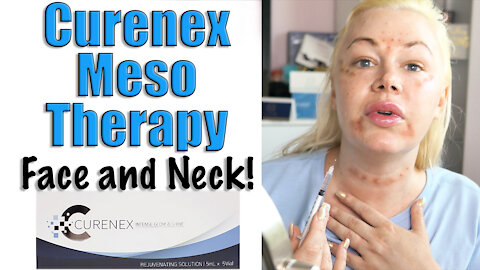 Curenex Meso Therapy for your face and Neck | Code Jessica10 saves you $$$