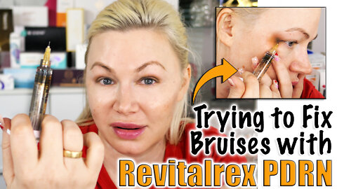 Will Revitalrex PDRN fix a Bruise from www.celestapro.com | Code Jessica10 Saves you Money!