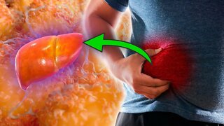 How to Reverse and Prevent Fatty Liver Disease