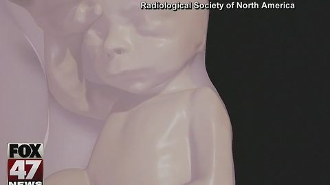 3D ultrasounds for better visual of fetus