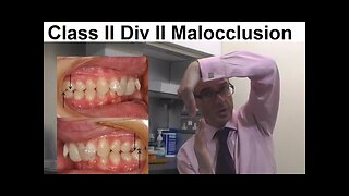 Why Class II Division II Malocclusion/ Inclined Teeth is Less Common in People by Dr Mike Mew