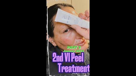 Second VI Peel - (PART 3 Post Treatment)