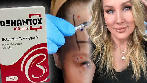 DEHANTOX FULL FACE // Mapping & Injections