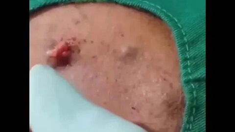 Remoção de Cravos e Espinhas - Remove Squeezing Blackheads and Pimples - Just Relax | Apenas Relaxe