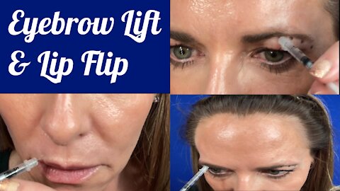 Eyebrow Lift | Lip Flip | Nabota