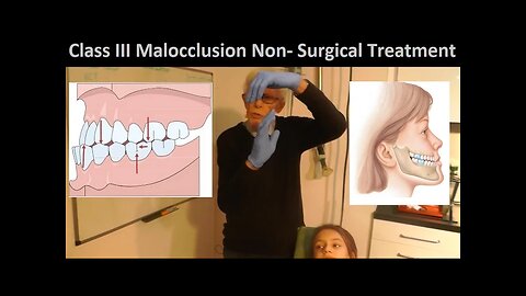 Correcting Class III Malocclusion without Tooth Extraction or Oral Surgery by Prof John Mew