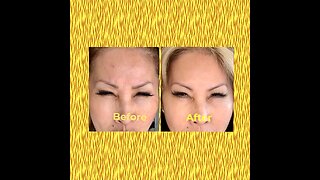 Doing my botox using Botulax at home