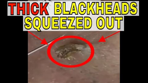 Two thick blackheads squeezed out 😱 #blackheadremoval #blackhead #blackheads #blackheadsremoval