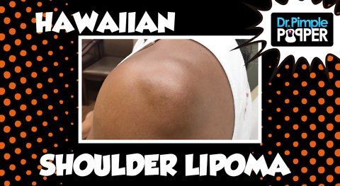 A Hawaiian Lipoma