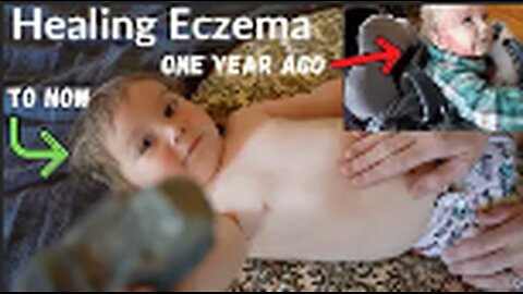 Aron Regimen 1 year later | Baby Eczema | Children with Eczema | Atopic Eczema | Dr. Sheila Kilbane