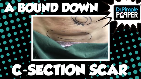 Release of Bound Down C section scar