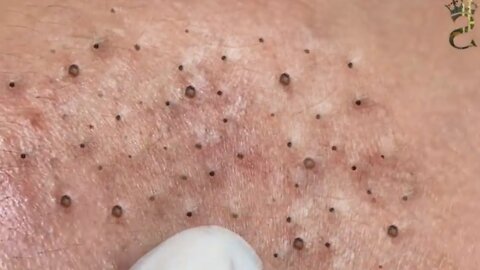 Removing Acne and Blackheads Treatment, #33