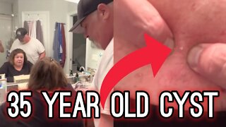 35 YEAR OLD Cyst | Satisfying HARD POP and BLACKHEAD Removal | #TheBubbaArmy