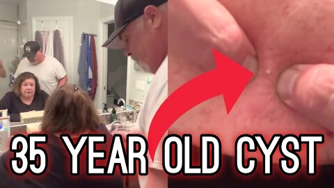 35 YEAR OLD Cyst | Satisfying HARD POP and BLACKHEAD Removal | #TheBubbaArmy