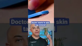 Doctor reacts to skin tag removal!