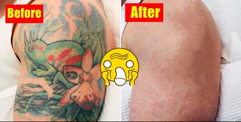 Tattoo removal with laser!!