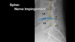 Spine Nerve Impingement