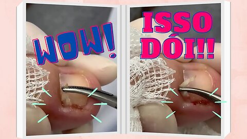 Podóloga remove unha encravada dolorosa: veja procedimento em ação #ingrown_toenail #unhaencravada